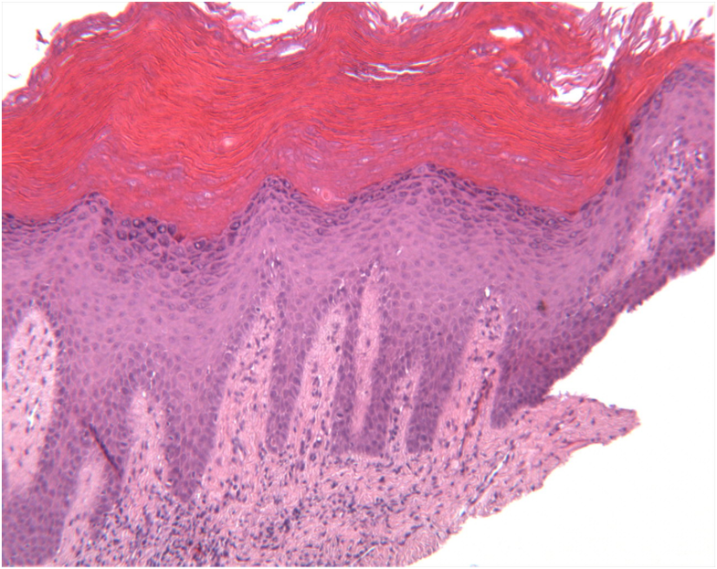 Diode laser surgery in the treatment of oral proliferative verrucous