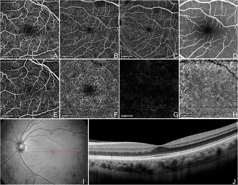 A review of optical coherence tomography angiography (OCTA
