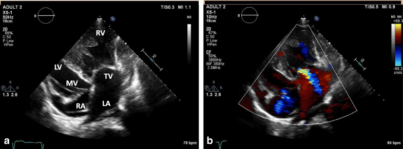 Case report: new onset heart failure in congenitally corrected transposition of the great ...