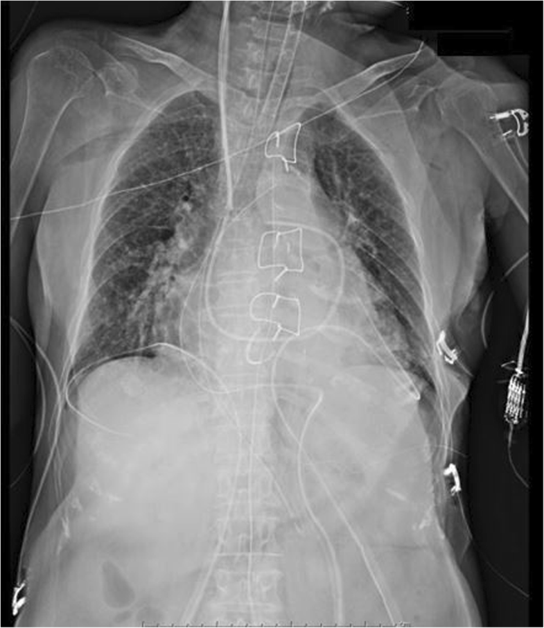 A case of esophageal perforation after intraoperative transesophageal