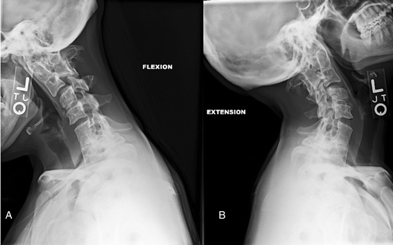 Dangers of cervical traction image