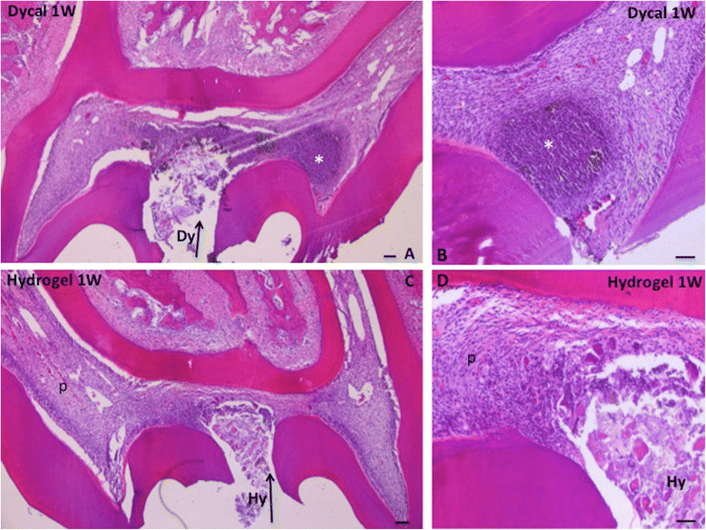 Reactionary and reparative dentin formation after pulp capping