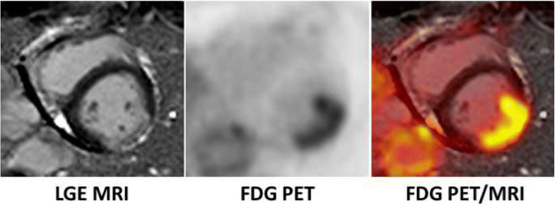 Cardiac PET/MRI—an update | European Journal of Hybrid Imaging | Full Text