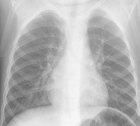The radiological diagnosis of pneumonia in children