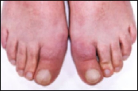 Pretibial Myxedema | SpringerLink