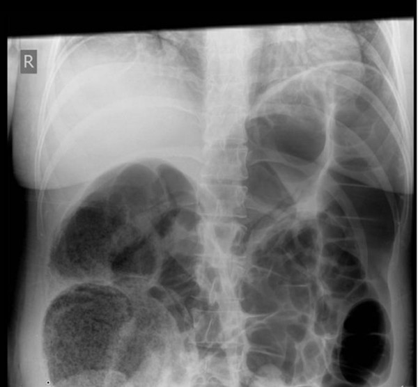 Ogilvie's syndrome with caecal perforation after Caesarean section a case report Journal of