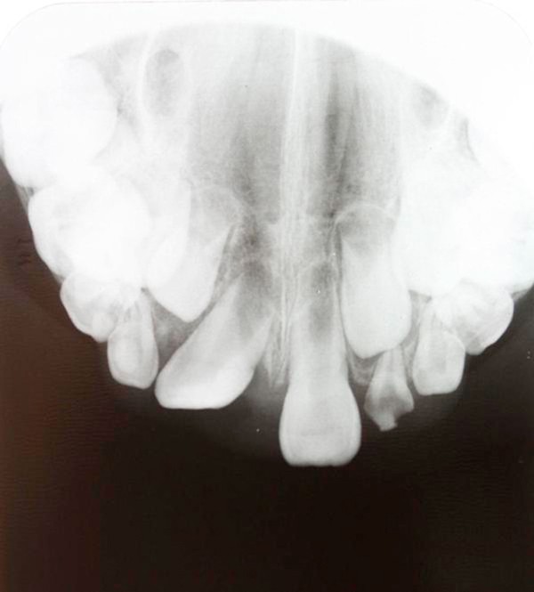 crossbite recession tooth occlusion buccal traumatic gingival resulted