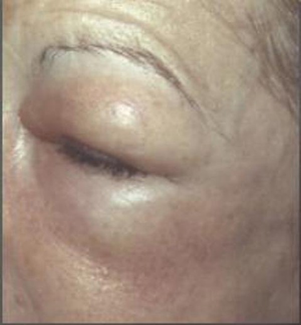 periorbital oedema and surgical emphysema an unusual subcutaneous emphysema