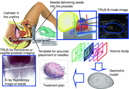 Dimensiuni prostata