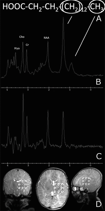 Cerebral Lipid Accumulation Detected By Mrs In A Child With Carnitine Palmitoyltransferase 2 Deficiency A Case Report And Review Of The Literature On Genetic Etiologies Of Lipid Peaks On Mrs Springerlink