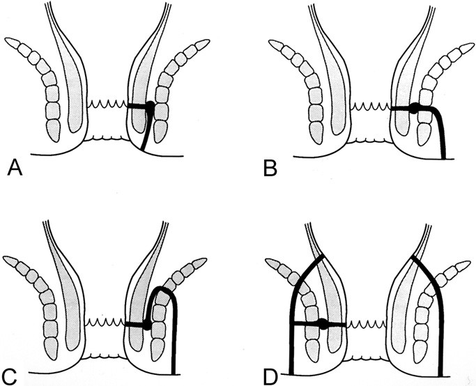 Benign Anorectal: Abscess and Fistula | SpringerLink Benign Anorectal: Abscess and Fistula | SpringerLink