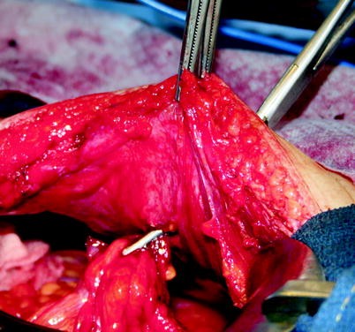 Colostomy: Types, Indications, Formation, and Reversal | SpringerLink