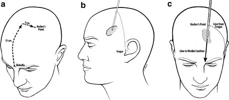 Intracranial Monitoring Springerlink