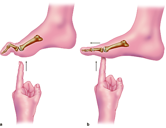 Surgical Treatment of Hammer Toe, Claw Toe, and Mallet Toe Deformity