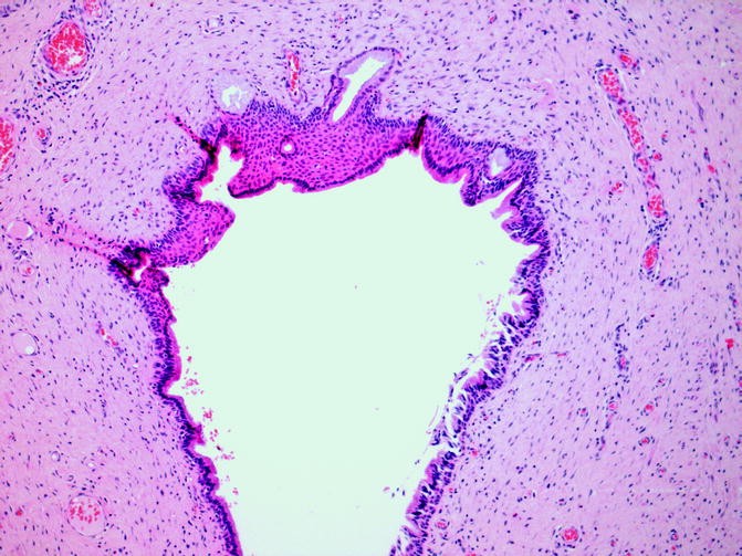 Cysts Non Neoplastic Glandular Lesions And Glandular Neoplasms Of The Vulva And Vagina Springerlink Cysts Non Neoplastic Glandular Lesions And Glandular Neoplasms Of The Vulva And Vagina Springerlink