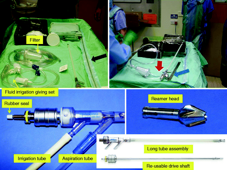 Autologous Bone Graft Harvesting with the Use of RIA (Reamer Irrigator