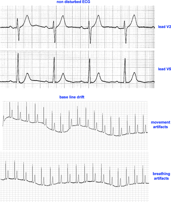 An Introduction to ECG Signal Processing and Analysis | SpringerLink