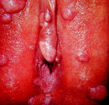 Benign Diseases Of The Vulva Springerlink