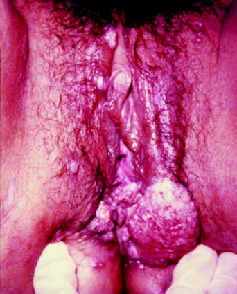Benign Diseases Of The Vulva Springerlink