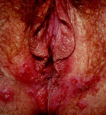 Benign Diseases Of The Vulva Springerlink