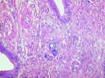 Endometrial dating histopatologi