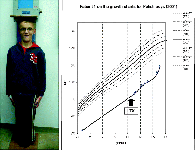 Alagille Syndrome Growth Chart