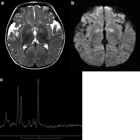 Eyelid And Facial Nerve Disorders Sciencedirect
