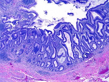 Frozen Section Evaluation Of The Appendix Springerlink - 