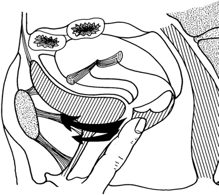 Pelvic Floor Dysfunction in Bladder Pain Syndrome | SpringerLink