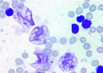 Overall Assessment Of The Aspirate Diagnostic Clues Springerlink