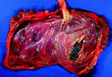 Placental Shape Aberrations | SpringerLink