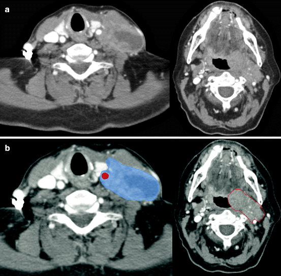 Head and Neck Lymph Node Anatomy | SpringerLink