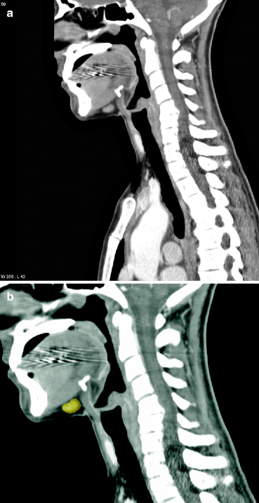 Head and Neck Lymph Node Anatomy | SpringerLink