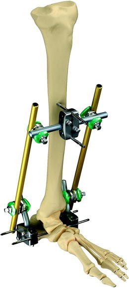 The Use of External Fixators in the Acute Management of Tibial Pilon ...