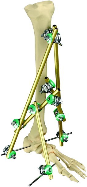 The Use of External Fixators in the Acute Management of Tibial Pilon ...