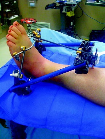The Use of External Fixators in the Acute Management of Tibial Pilon ...