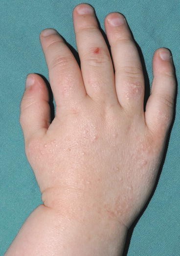 Xeroderma Hands