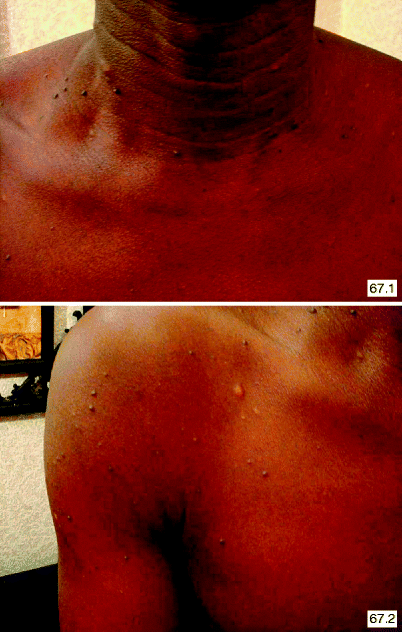 Bluish Discrete Follicular Papules Of Gradual Onset Springerlink