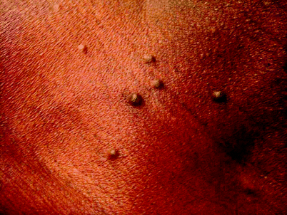 Bluish Discrete Follicular Papules Of Gradual Onset Springerlink