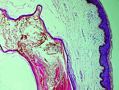 Bluish Discrete Follicular Papules Of Gradual Onset Springerlink