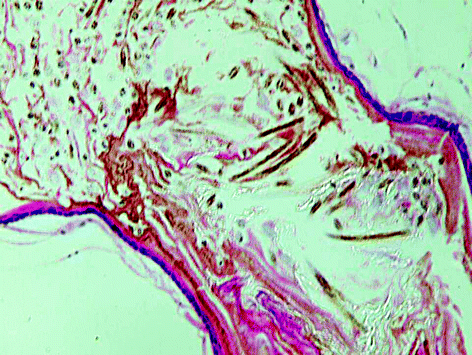 Bluish Discrete Follicular Papules Of Gradual Onset Springerlink