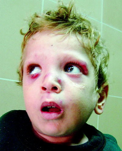 A Child With Hypopigmented Skin Grey Hair Neurological And