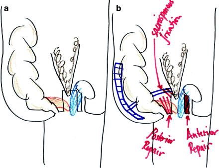 Management Of Prolapse Springerlink Management Of Prolapse Springerlink