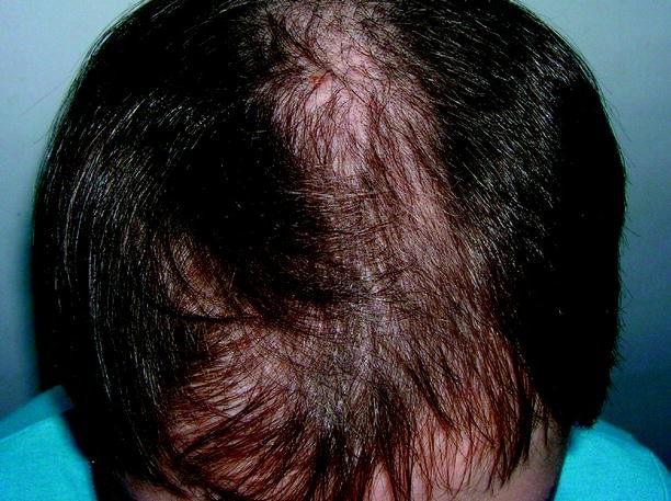 Trichotillomania And Traction Alopecia Springerlink