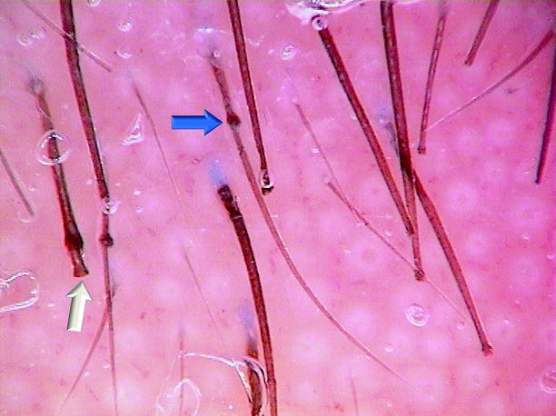 Trichorrhexis Invaginata and Netherton’s Syndrome | SpringerLink