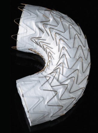 Endovascular Management Of Aortic Aneurysmal And Stenotic Disease Springerlink