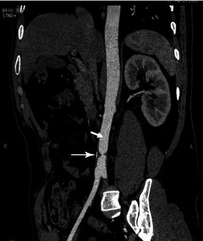 Endovascular Management Of Aortic Aneurysmal And Stenotic Disease Springerlink Endovascular Management Of Aortic Aneurysmal And Stenotic Disease Springerlink