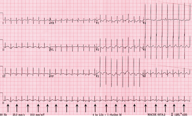 Supraventricular Tachycardias Springerlink