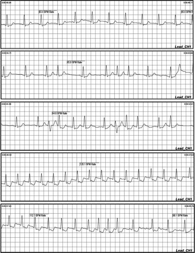 Ambulatory Monitoring: (Holter, Event Recorders, External, and ...