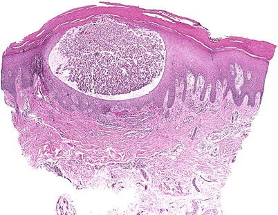 palmoplantar pustular psoriasis pathology